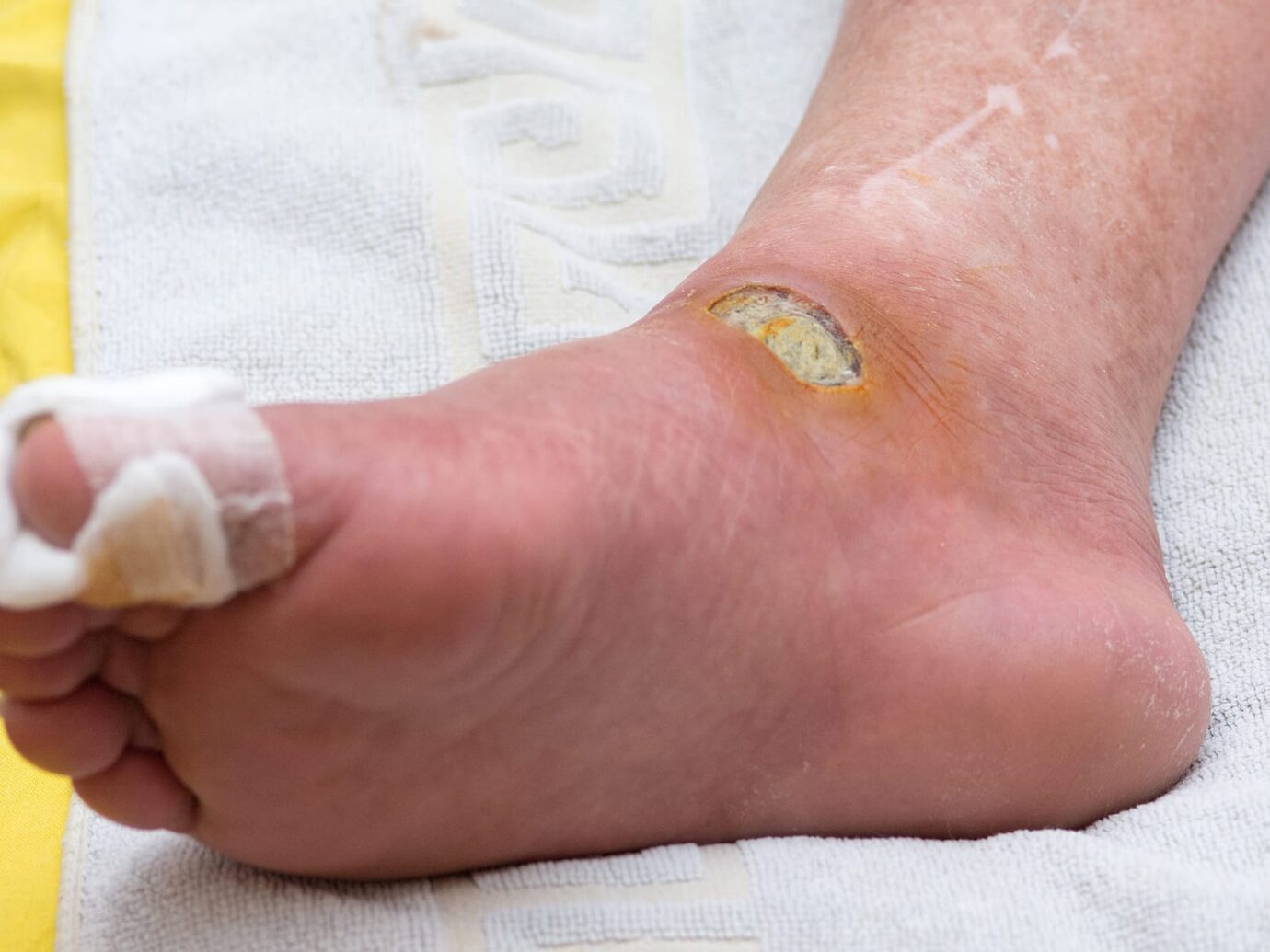 Foot ulcer