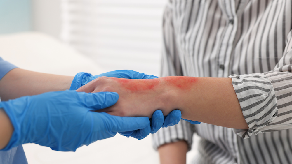 burn care